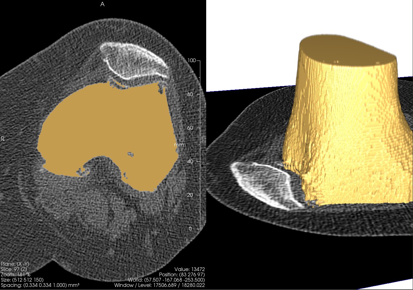 Aus den CT-Daten rekonstruiertes 3D-Oberflächenmodell des Femurs